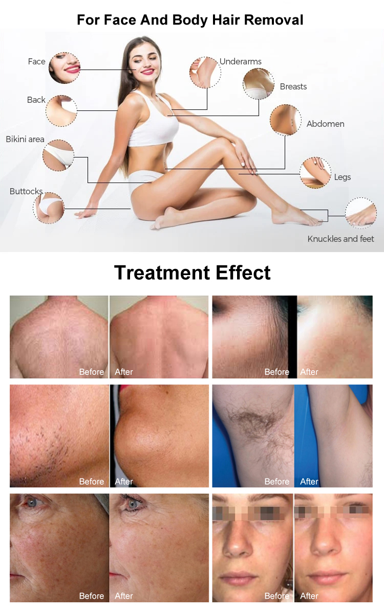 4 Wavelength laser hair removal08
